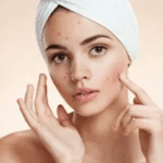maneiras naturais de se livrar da acne