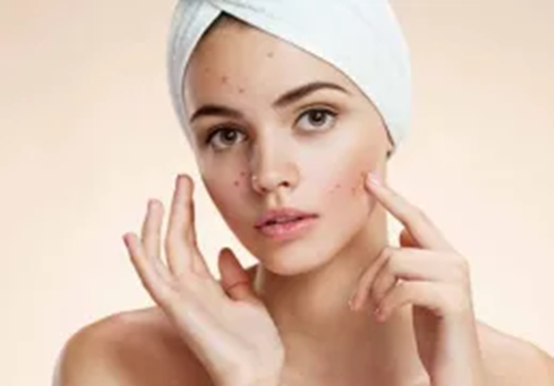 maneiras naturais de se livrar da acne
